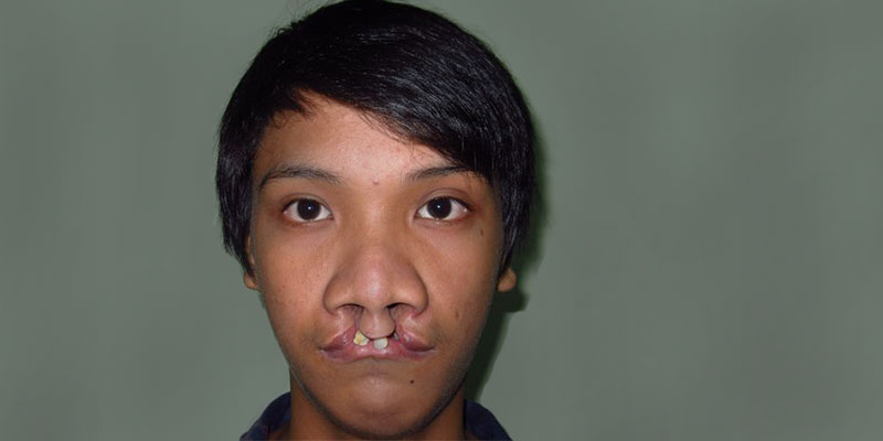 Joseph vor der Operation einer Lippen-Kiefer-Gaumenspalte